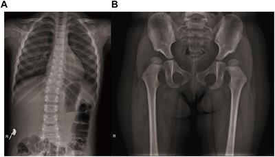 Whole Exome Sequencing Identified a Novel Biallelic SMARCAL1 Mutation in the Extremely Rare Disease SIOD